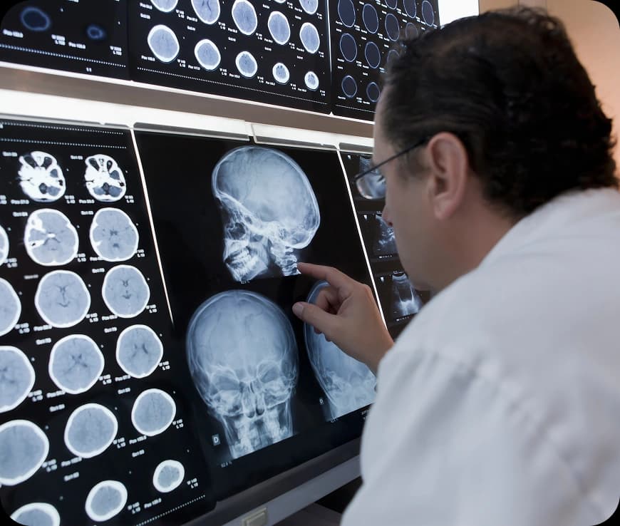 Brain Tumour Stages and Grading Explained