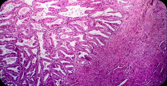 Endometrial Carcinoma