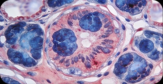 Lymphoma of the Stomach