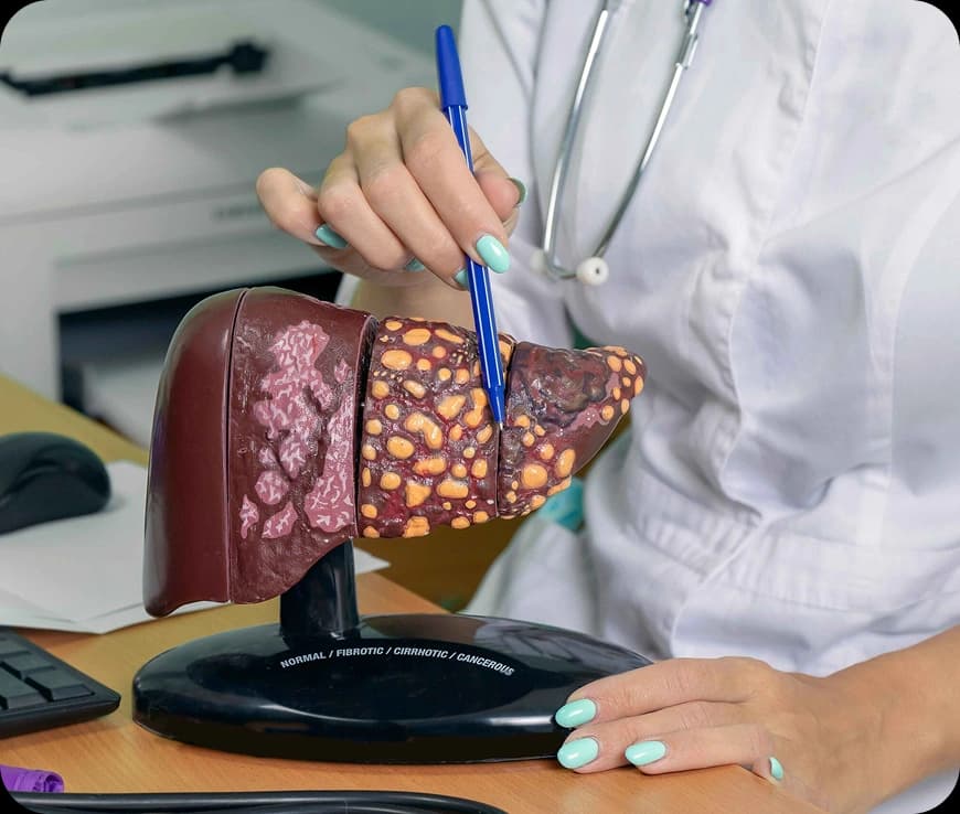  Liver Cancer Stages Explained