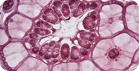 Acinar Cell Carcinoma