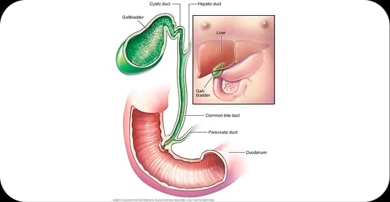 Distal Cholangiocarcinoma