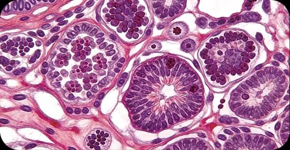 Lymphoma 