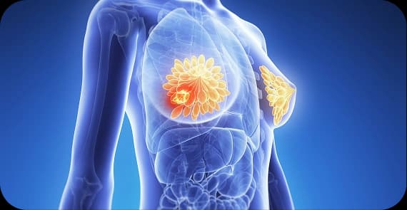 Triple-Negative Breast Cancer