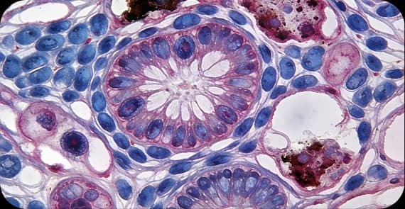 Wilms Tumour