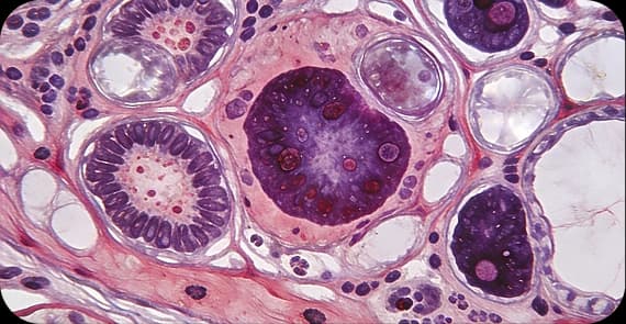 Transitional Cell Carcinoma