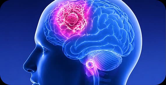 Glioblastoma (GBM) 