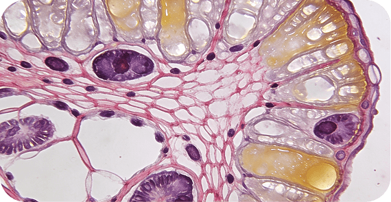 Mucinous Cystic Neoplasm (MCN)