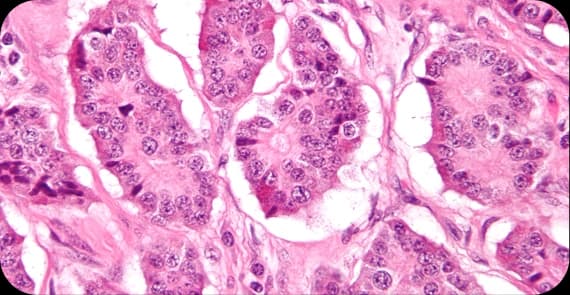 Neuroendocrine Tumours