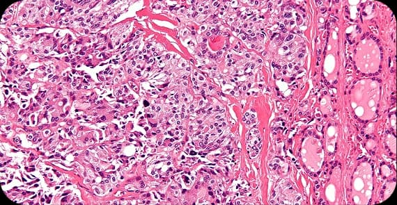 Medullary Thyroid Cancer