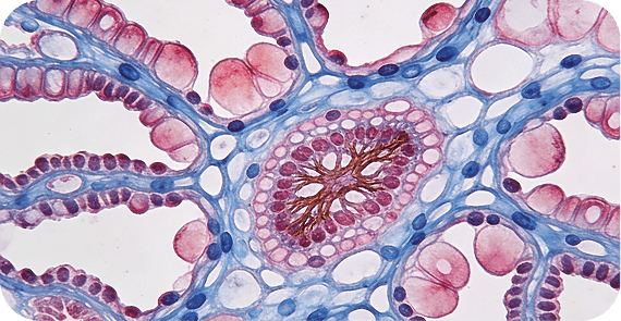  Intraductal Papillary Mucinous Neoplasm (IPMN)