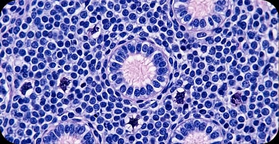 Medulloblastoma 