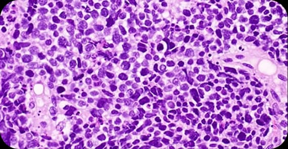 Small Cell Carcinoma