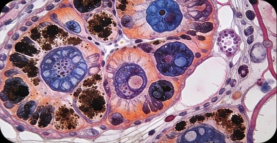 Melanoma & Other Rare Carcinomas