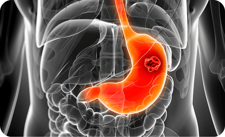 What Is Oesophageal Cancer?