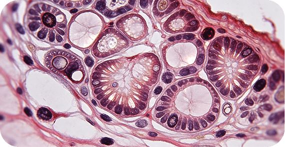 Pancreatic Ductal Adenocarcinoma (PDAC)