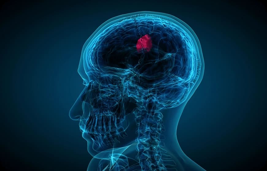Risk Factors for Brain Tumour