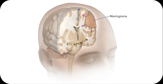 Meningiomas