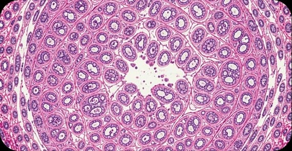 Signet Ring Cell Carcinoma