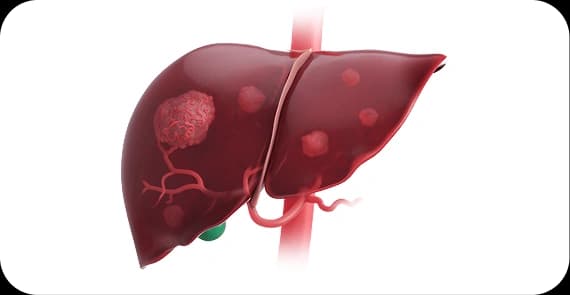 Hepatocellular Carcinoma