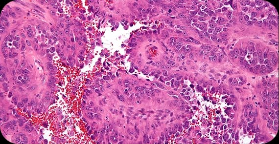 Angiosarcoma