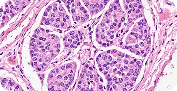 Carcinoid Tumours 