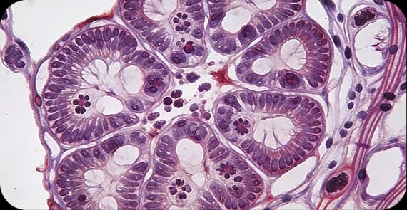 Uterine Carcinosarcoma 