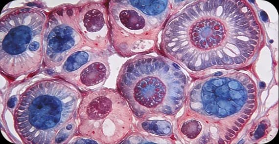 Epithelial Ovarian Cancer