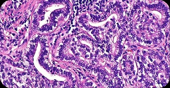 Adenocarcinoma