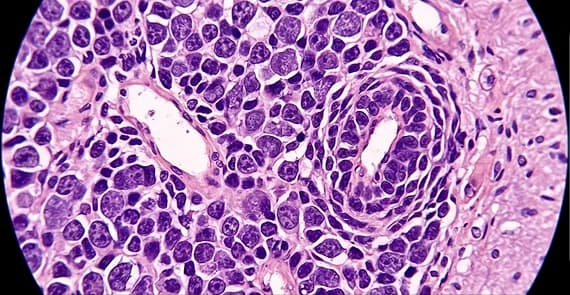 Brain Lymphoma 
