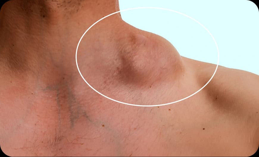 What Is Lymphoma Cancer?