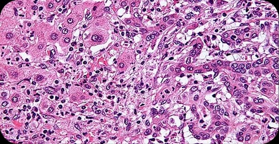 Perihilar Cholangiocarcinoma