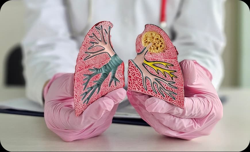 What Is Lung Cancer?