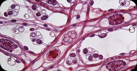Renal Sarcoma