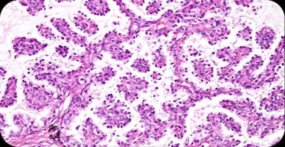 Papillary Adenocarcinoma