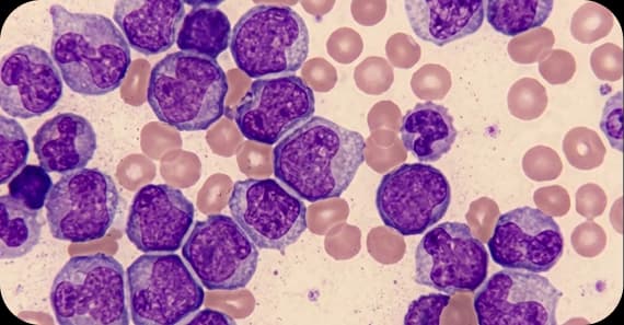 Leukaemia