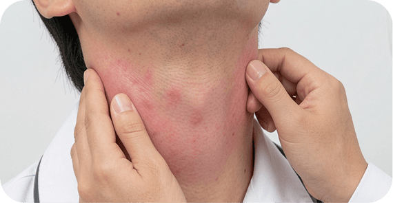 Hodgkin Lymphoma (HL)