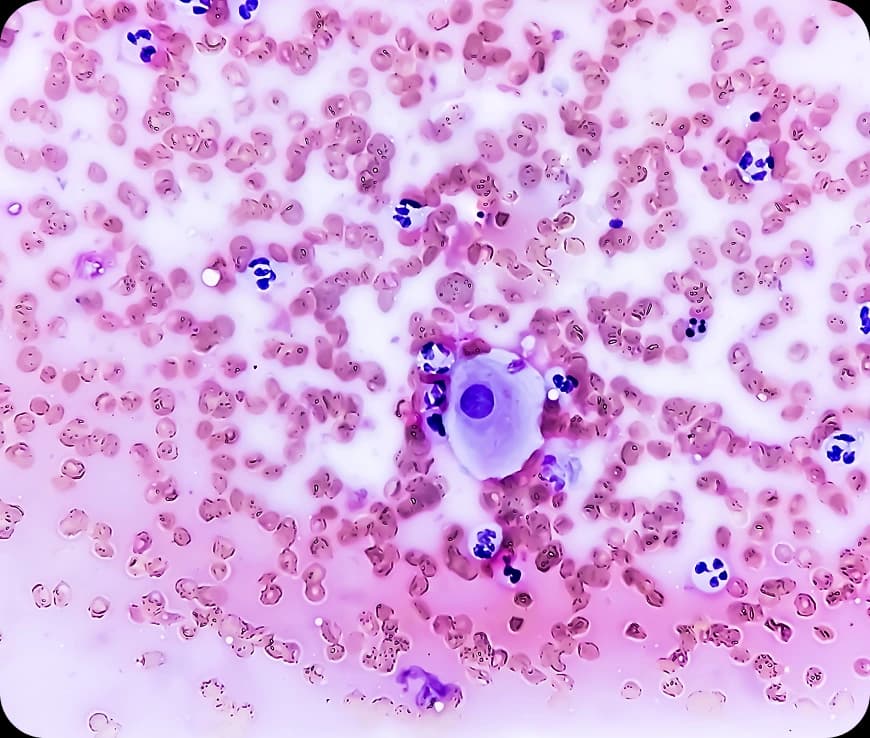 Ovarian Cancer Stages Explained