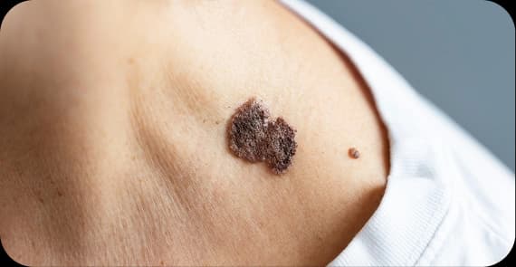 Squamous Cell Carcinoma