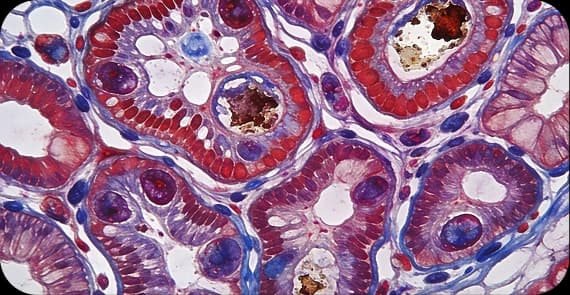 Adenocarcinoma 
