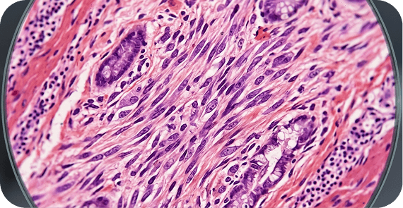 Sarcomas 