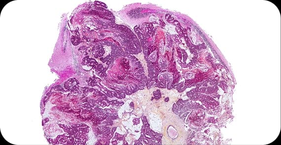 Metastatic Brain Tumours