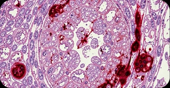 Sarcomas 