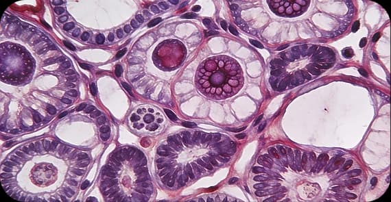 Laryngeal Cancer