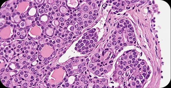 Follicular Thyroid Cancer 