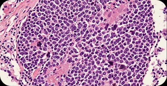 Small Cell Lung Cancer (SCLC)