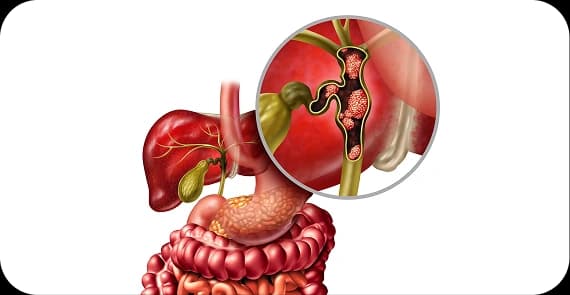 Intrahepatic Cholangi