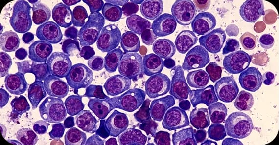 Multiple Myeloma