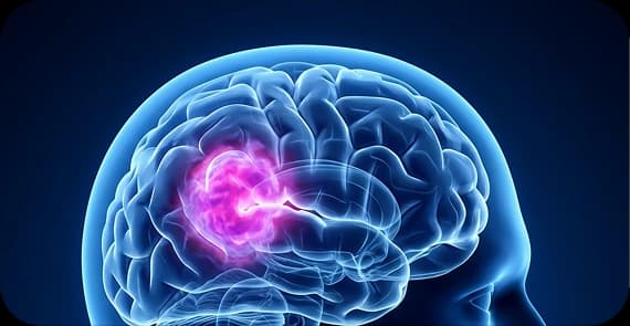 Astrocytoma 