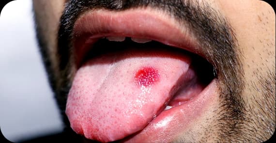 Oral Tongue Cancer